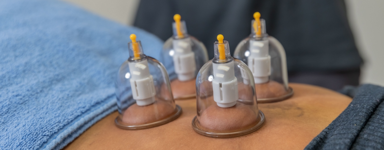 cupping-therapy-hands-of-hope-physical-therapy-Atlanta-GA